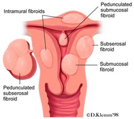 Uterine Fibroids